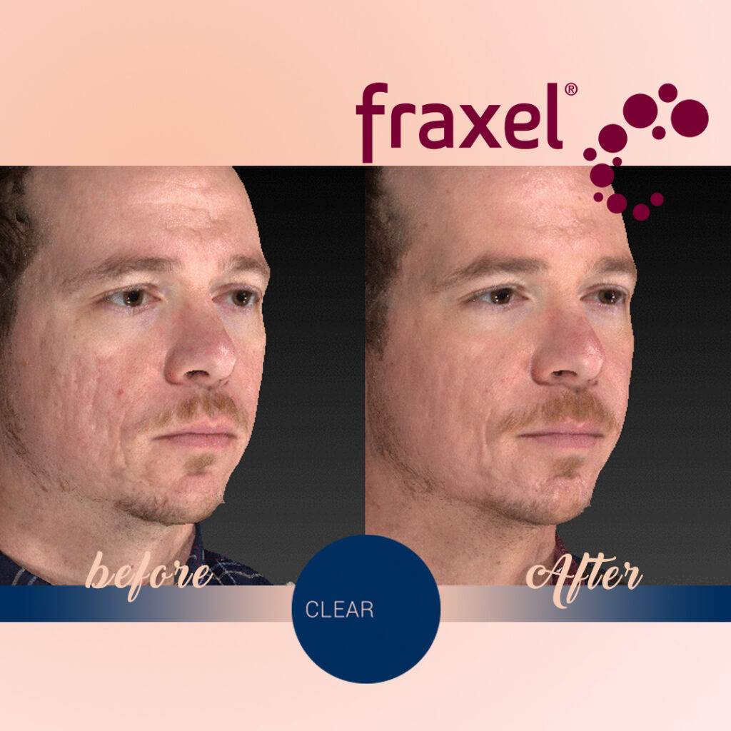 Before & After Fraxel 2