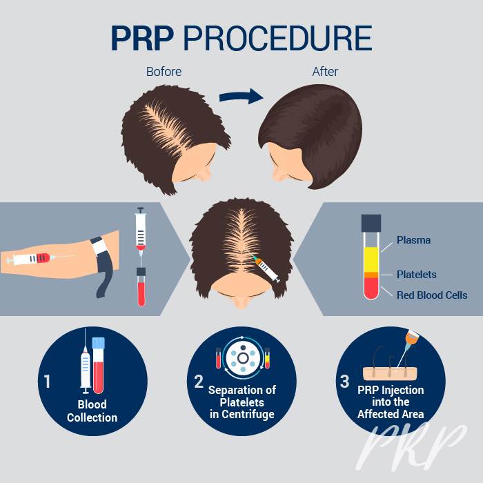 Hair Treatment PRP Procedure