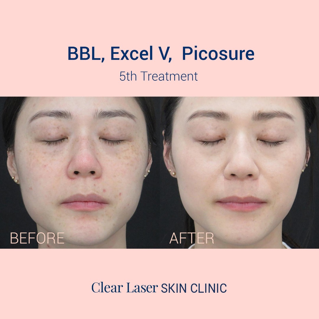 Before & After Picosure Therapy