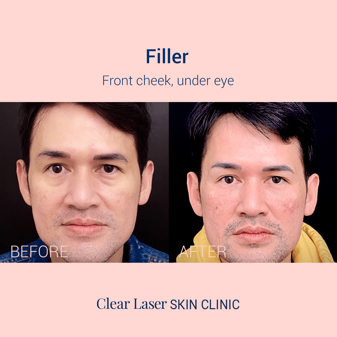 Clear Laser Skin Filler before and after result